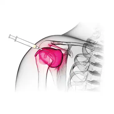 Infiltration de cortisone 